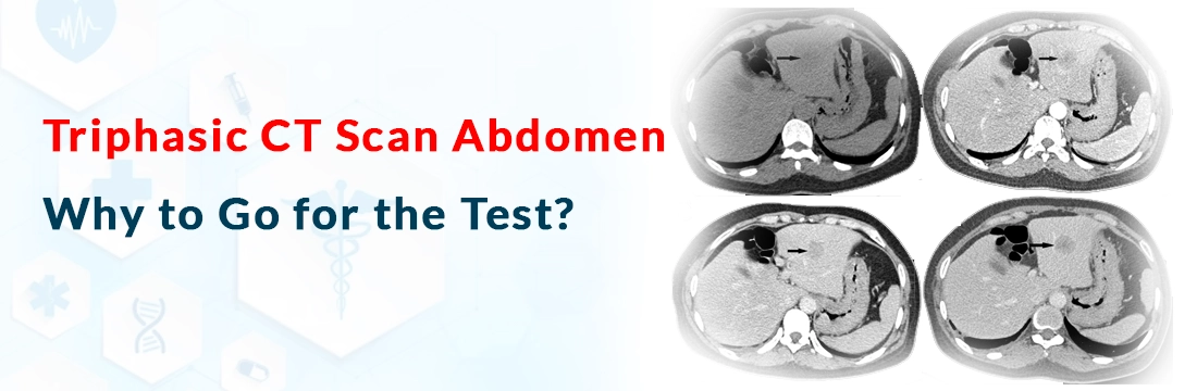 Triphasic CT Scan Abdomen: Why to Go for the Test?